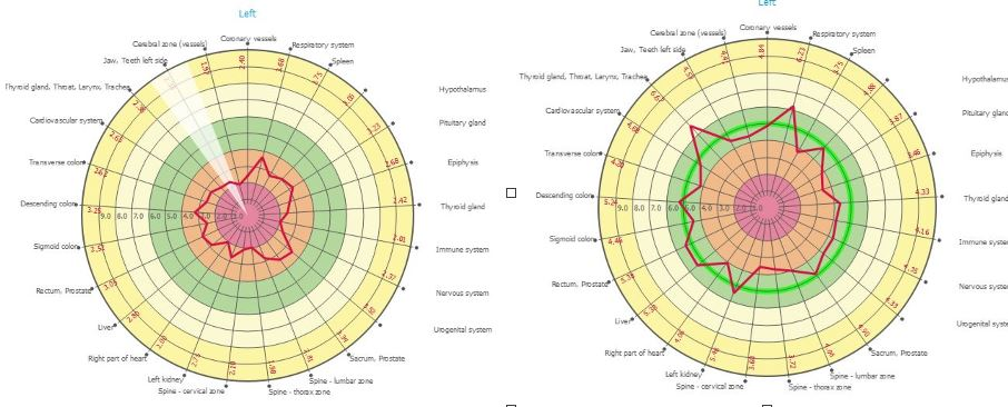 Fast-Stroke-Recovery-with-Spooky2-Remarkable-Results-in-14-Day
