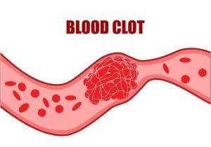 Blood Clot