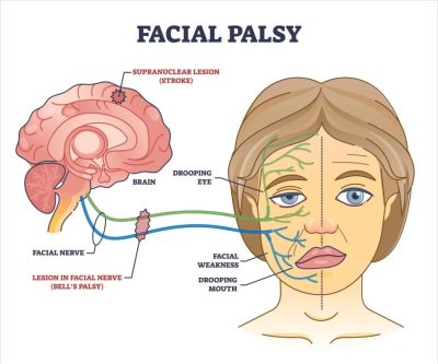 facial-palsy facial-palsy