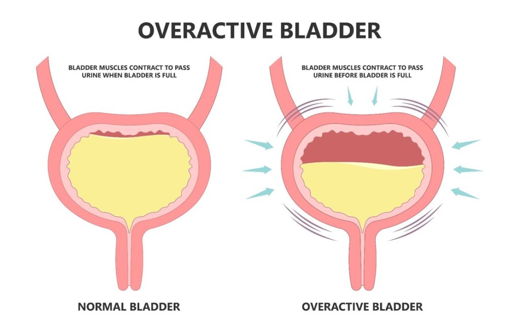 overactive bladder overactive bladder