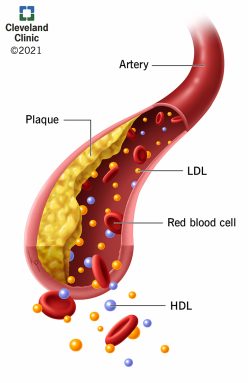21656-hyperlipidemia-illustration