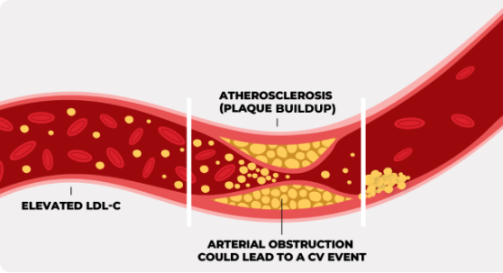 LDL and Atherosclerosis LDL and Atherosclerosis