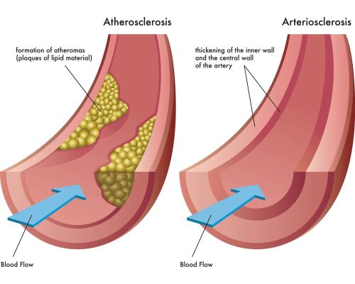 atherosclerosis-and-arteriosclerosis atherosclerosis-and-arteriosclerosis